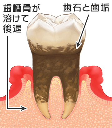 歯肉炎