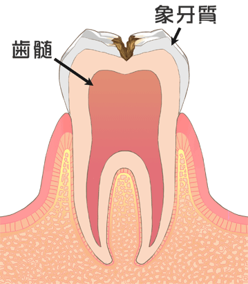 C2:象牙質まで進んだむし歯のイラスト