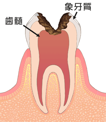 C3:歯髄まで進んだむし歯のイラスト