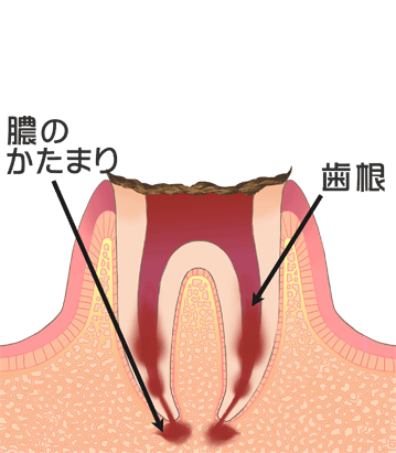 C4:末期のむし歯のイラスト