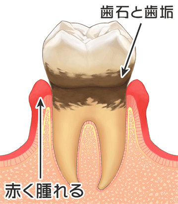 歯周病初期のイラスト