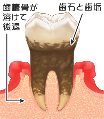 歯周病中期のイラスト