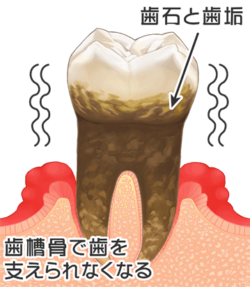 歯周病重度のイラスト